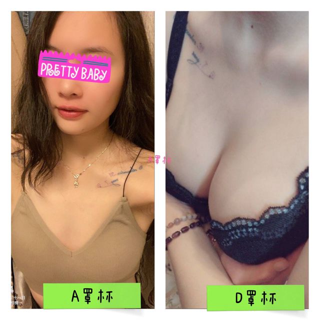 我是給林醫生手術的👋從A罩杯到D罩杯，其它醫生都說不能放這麼大，只有林醫生可以
做到我想要的樣子，而且也沒有球感或是水波紋之類的