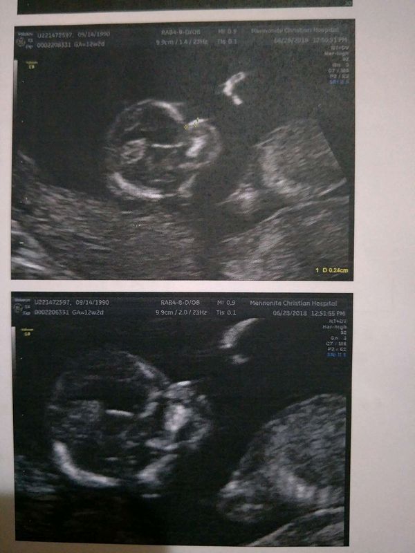 初期唐氏症超音波 媽咪愛 育兒問答