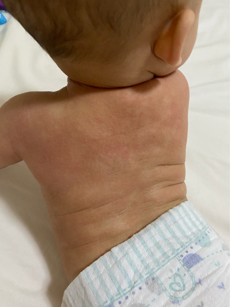 寶寶皮膚紅紅一點點是汗疹嗎？