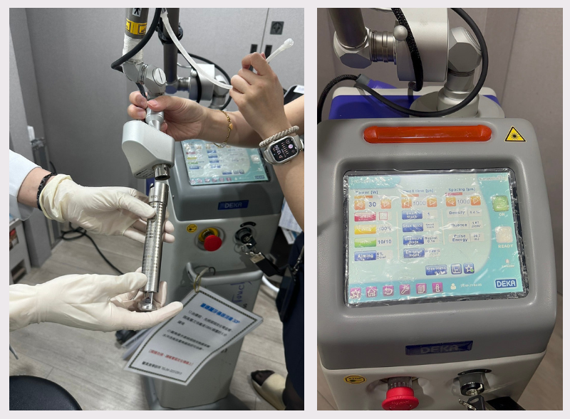 做了蒙娜麗莎私密雷射，擺脫惱人發炎人生